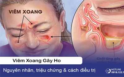 Viêm xoang gây ho: Nguyên nhân, triệu chứng & cách điều trị