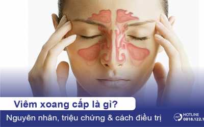 Viêm xoang cấp: Nguyên nhân, dấu hiệu và cách điều trị