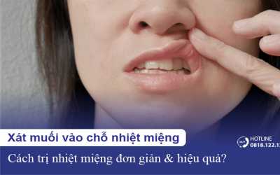 Có nên xát muối vào nhiệt miệng để trị vết loét nhiệt?