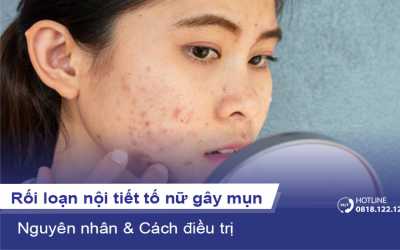 Rối loạn nội tiết tố nữ gây mụn ở người trưởng thành