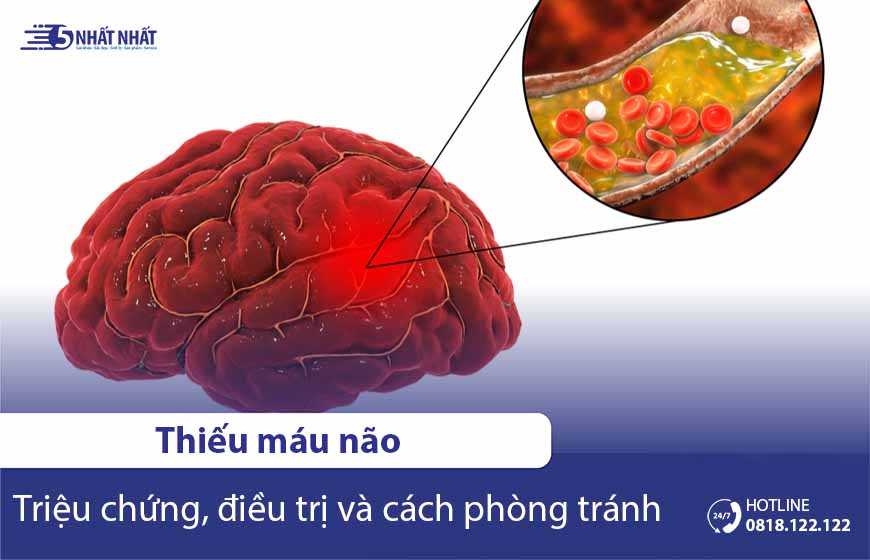 7 Triệu chứng & 5 Nguyên nhân của bệnh thiếu máu não | Kèm dấu hiệu