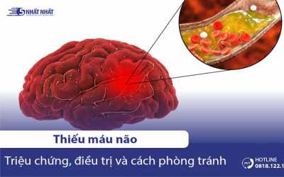 7 Triệu chứng & 5 Nguyên nhân của bệnh thiếu máu não | Kèm dấu hiệu