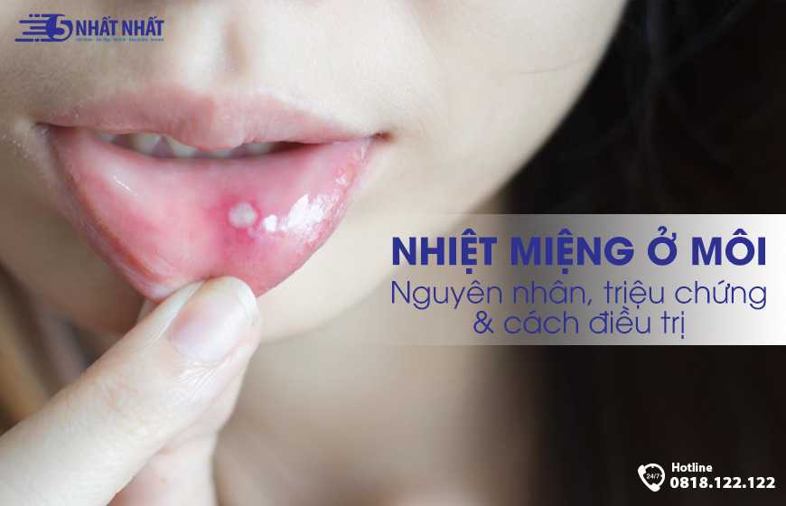 Nhiệt miệng ở môi: Cách phòng ngừa và điều trị