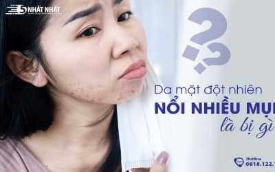 Da mặt đột nhiên nổi nhiều mụn do đâu? Hướng dẫn cách điều trị