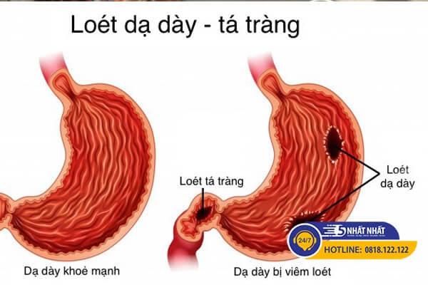 chứng viêm loét tá tràng