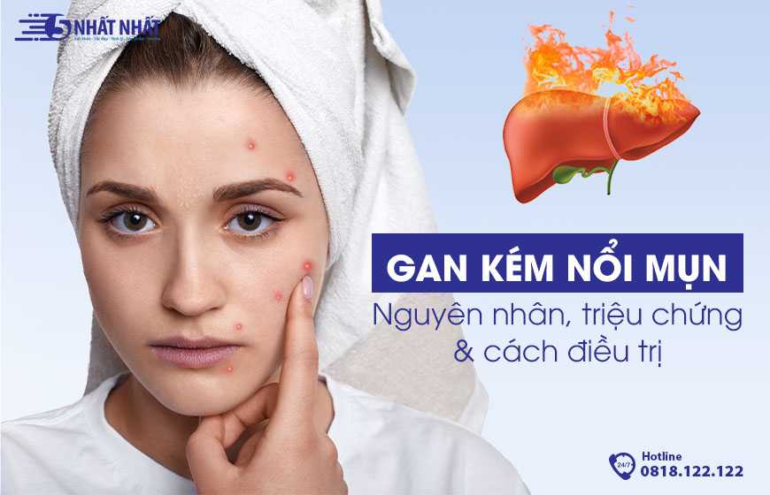 Gan kém nổi mụn: Nguyên nhân, triệu chứng & cách điều trị