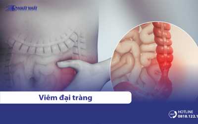 Viêm đại tràng: Nguyên nhân, dấu hiệu, triệu chứng & cách điều trị