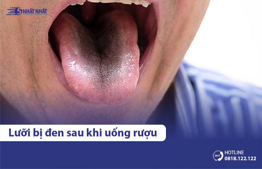 Vì sao lưỡi bị đen sau khi uống rượu? Có nguy hiểm không?