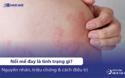 Nổi mề đay mẩn ngứa: Triệu chứng, nguyên nhân & cách điều trị