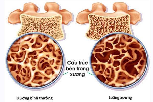 Thiếu hụt estrogen gây loãng xương ở cả nam và nữ