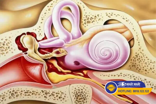 Bệnh Meniere là bệnh gì?