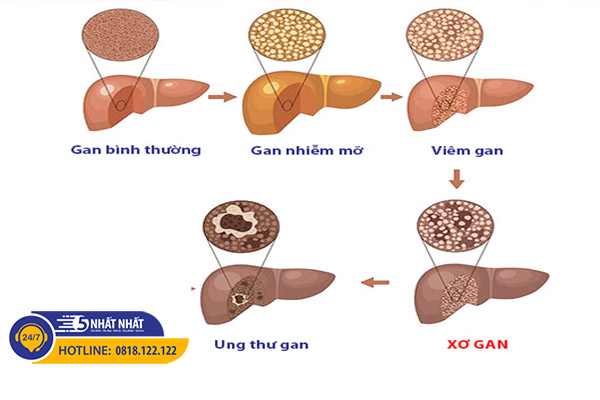 các giai đoạn của bệnh xơ gan do rượu