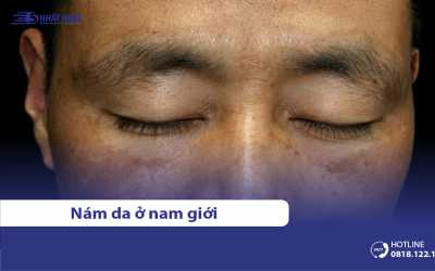 Nguyên nhân gây nám, sạm đen da ở nam giới & Cách trị hiệu quả