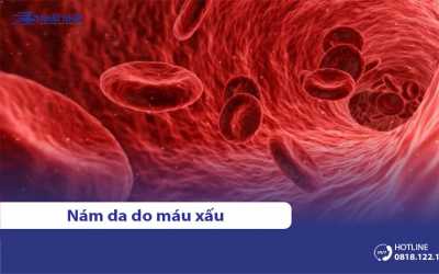 Nám da do máu xấu (nám máu): Nguyên nhân & cách điều trị