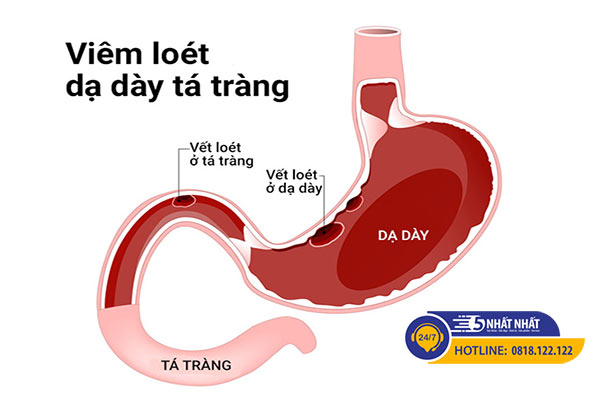 viêm loét dạ dày tá tràng