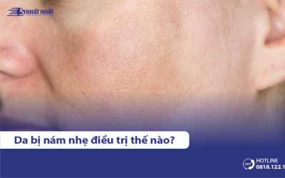 Da bị nám nhẹ phải làm sao? #9 cách làm mờ nám nhẹ hiệu quả