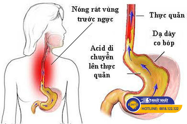 trào ngược dạ dày đau thượng vị