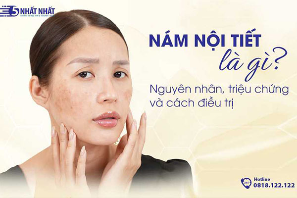 Nám nội tiết