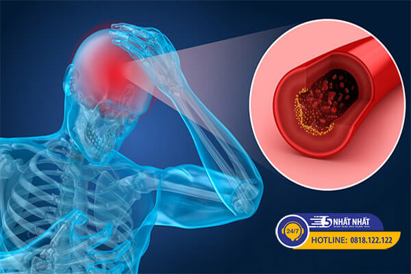 Thiếu máu não là nguyên nhân của bệnh đau đầu sau gáy