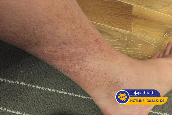 Lý do da chân bị sạm đen thường là do các vết nám