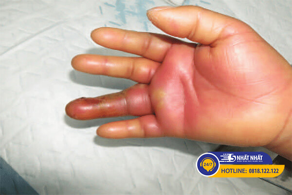 Gãy tay, bong gân ở ngón tay có thể gây sưng và ngứa
