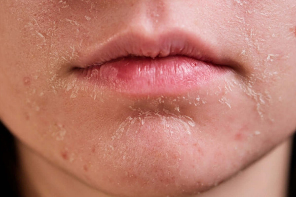 Da khô ráp, sần sùi là dấu hiệu da mặt đang thải độc
