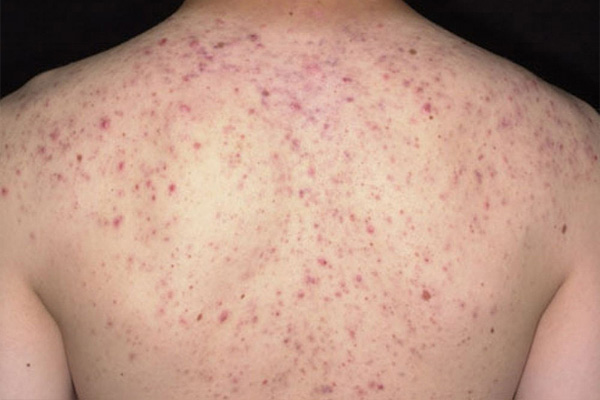 Mụn mọc li ti trên lưng hoặc da mặt là dấu hiệu gan thải độc qua da