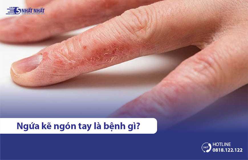 Ngứa kẽ ngón tay là triệu chứng bệnh gì? 8 cách trị hiệu quả nhất