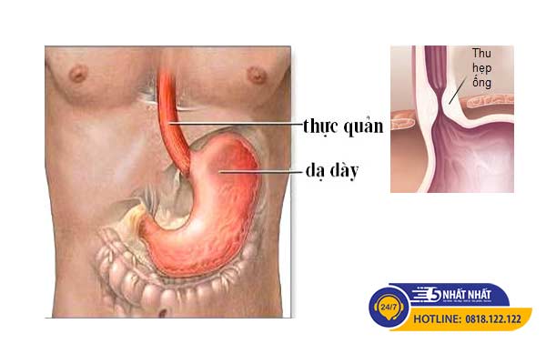 biến chứng trào ngược dạ dày gây khó thở