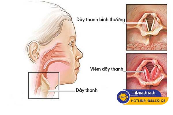 trào ngược dạ dày gây khó thở có nguy hiểm không