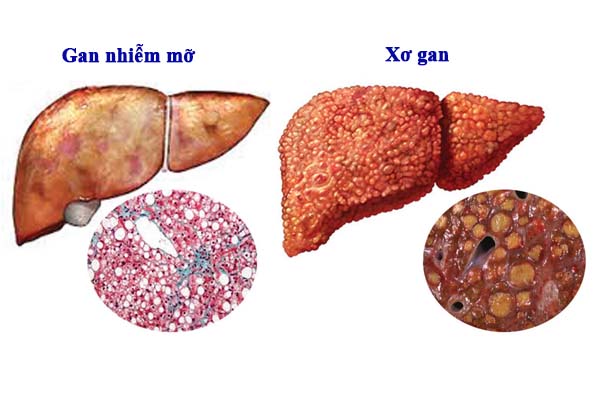 Điều trị gan nhiễm mỡ tại nhà