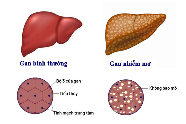 cách trị gan nhiễm mỡ tại nhà