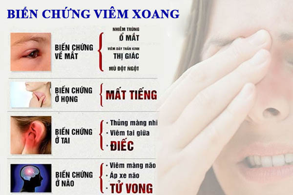 Bệnh viêm xoang có thể gây ra nhiều biến chứng nguy hiểm