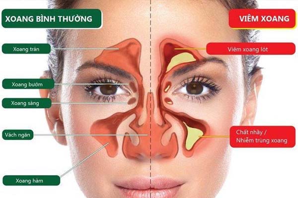 Phân loại viêm xoang theo vị trí xoang bị viêm