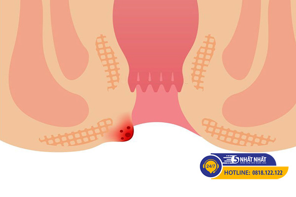 Cách nhận biết triệu chứng trĩ ngoại