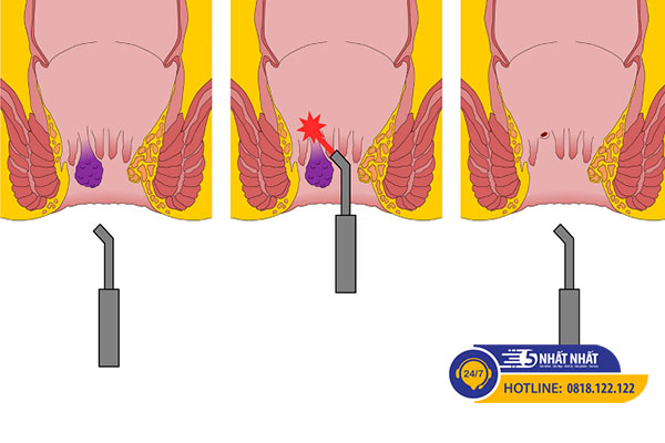 Cách trị bệnh trĩ hiệu quả