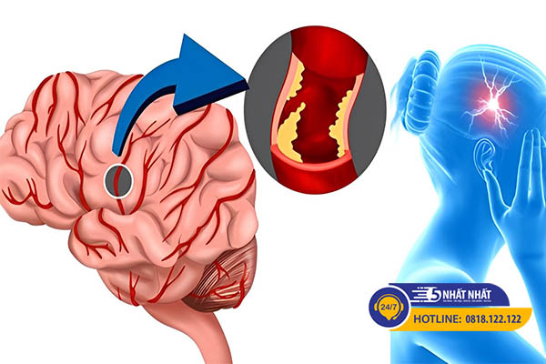 Phân biệt đau nửa đầu và đau đầu đột quỵ