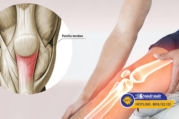 hội chứng đau xương bánh chè gây đau gối khi squat