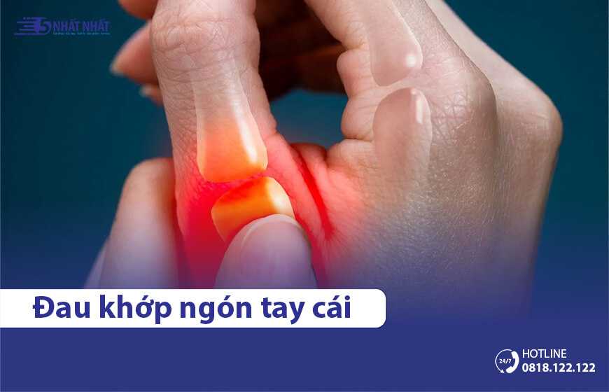 Đau khớp ngón tay cái là bệnh gì? Phải làm sao để điều trị?