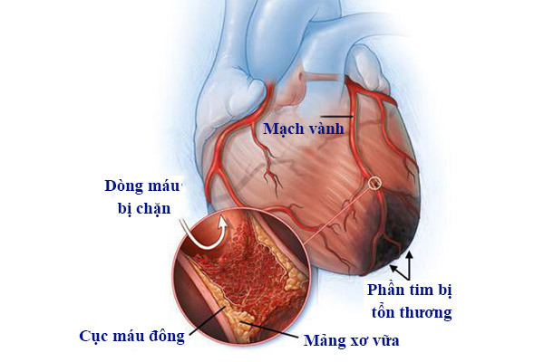 Chỉ số mỡ máu tăng cao gây ra nhiều bệnh tim mạch nguy hiểm