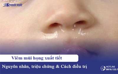 Viêm mũi họng xuất tiết nguy hiểm không? Chữa trị như thế nào?