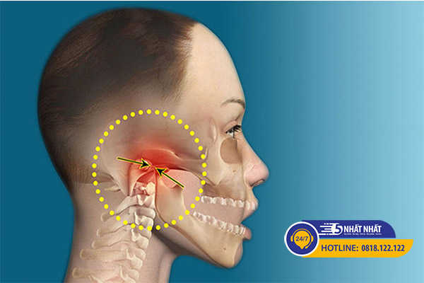 Bệnh rối loạn khớp thái dương hàm