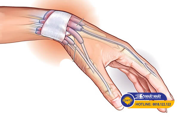 hội chứng ống cổ tay gây viêm khớp ngón tay