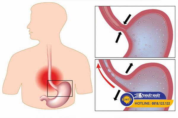 ho do trào ngược dạ dày