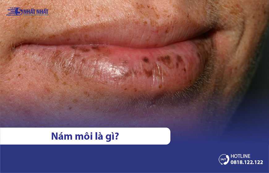 Xuất hiện vết nám, đốm đen trên môi: Nguyên nhân & Cách trị hiệu quả