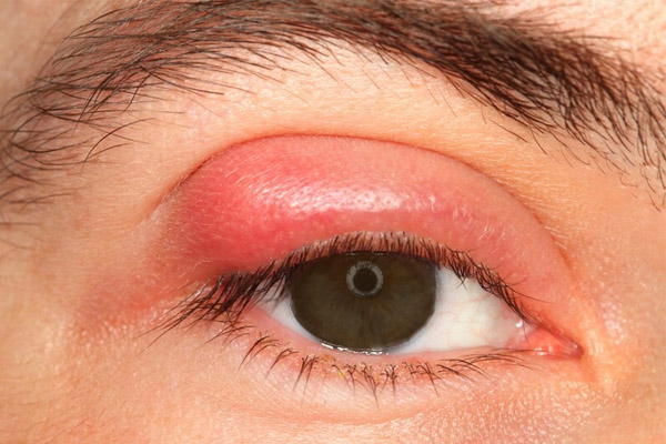 biến chứng viêm xoang ở mắt