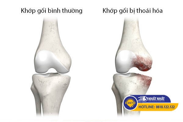 thoái hóa khớp gối có thể gây đau nhưng không sưng