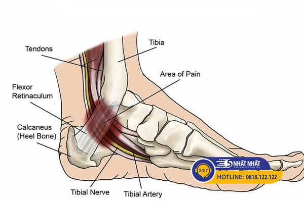 chứng đường hầm cổ chân gây đau khi chạy