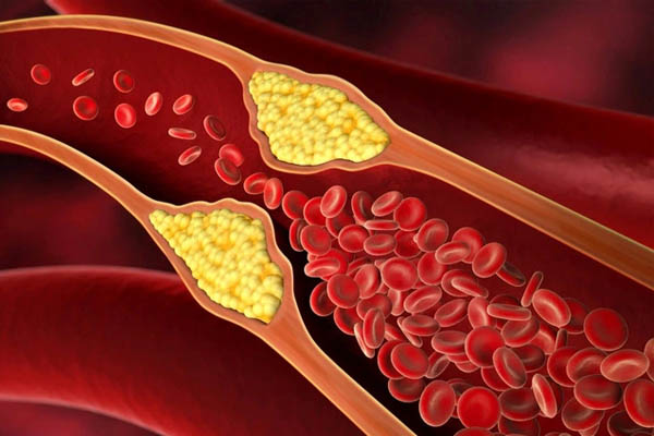 Nồng độ cholesterol trong máu thay đổi là một trong những dấu hiệu của tiền mãn kinh