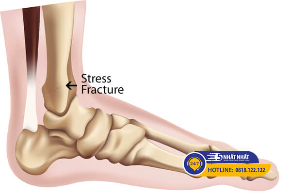 gãy xương do căng thẳng gây đau cổ chân